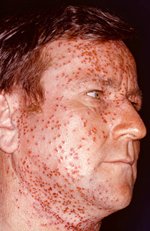 Eczema herpeticum with atopic dermatitis