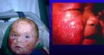 Oozing facial lesions secondary to Staphylococcal aureus superinfection