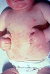 infant with atopic dermatitis
