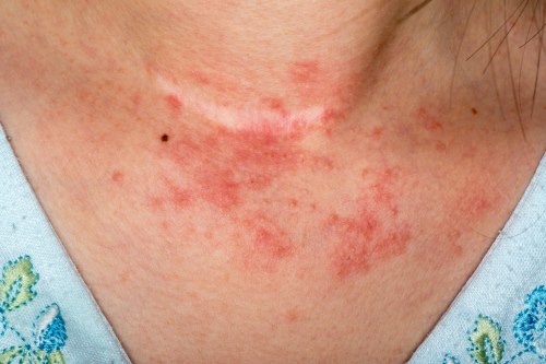 Resultado de imagen de dermatitis de contacto