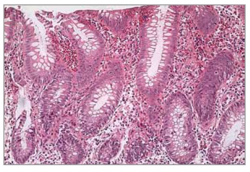 inflammatory bowel disease