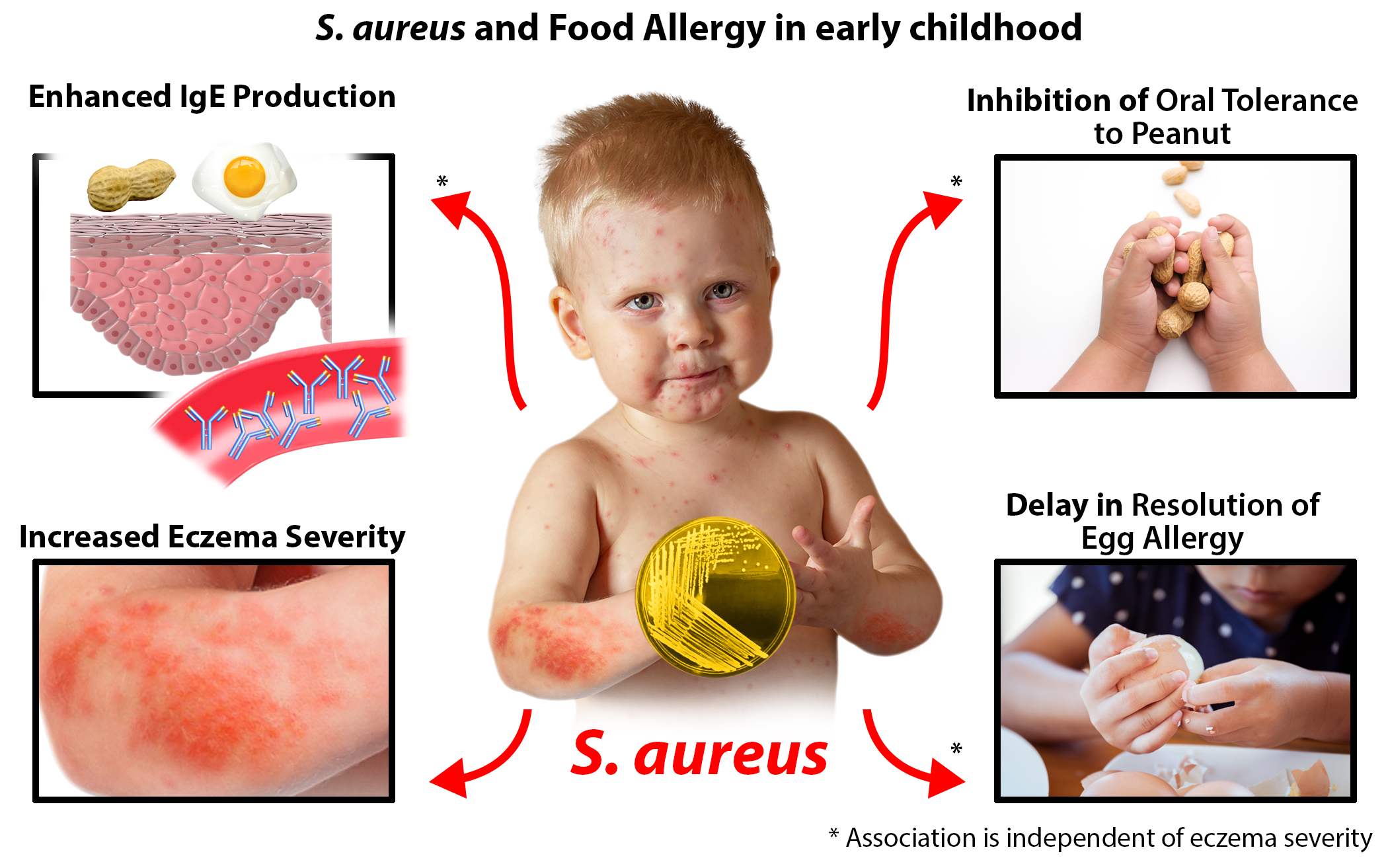 Bacteria S. aureus and the development of food allergy in