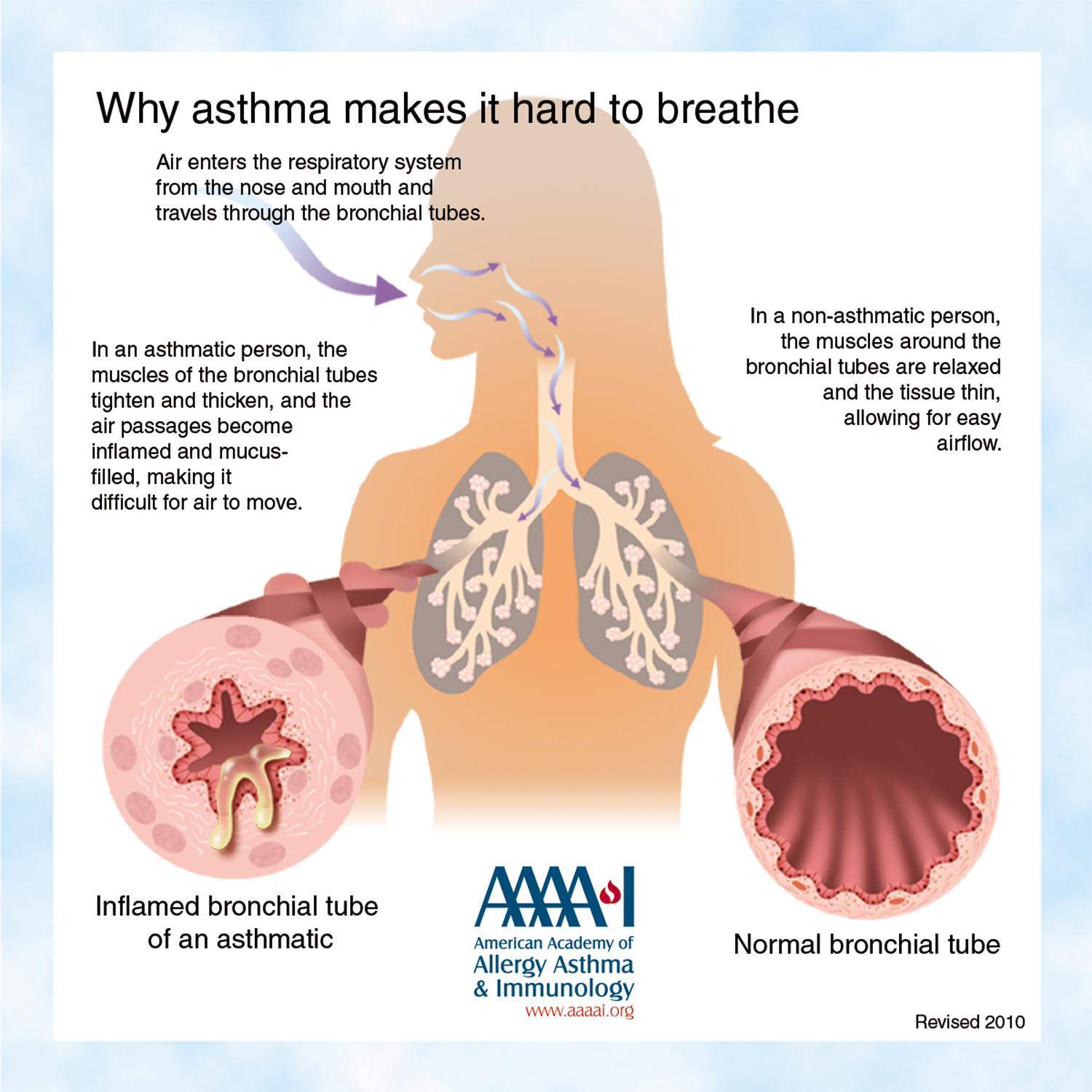 asthma