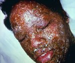 Severe eczema herpeticum Infections of skin in atopic dermatitis