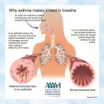 Asthma