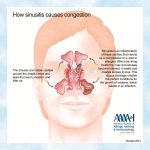 Sinusitis