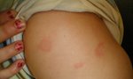 Urticaria