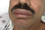 Angioedema of lips