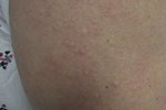 Cholinergic urticaria