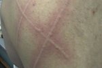 Dermatographic urticaria