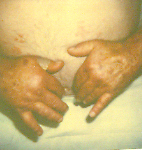 Hypocomplementemic urticarial vasculitis syndrome (HUVS)
