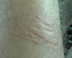 Pressure induced urticaria