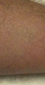 Pressure induced urticaria