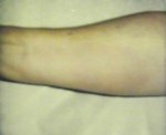 Vibratory urticaria