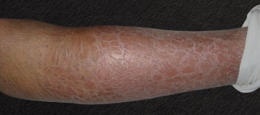 Asteatotic dermatitis