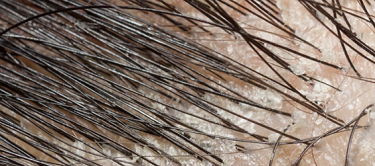 Seborrheic dermatitis