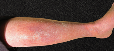 Stasis dermatitis