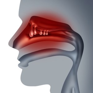 Pólipos nasales (Nasal Polyps) | AAAAI Pólipos nasales (Nasal Polyps) | AAAAI